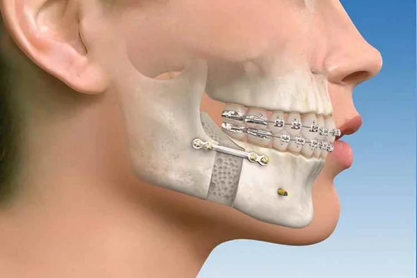 Jaw bone fracture treatment