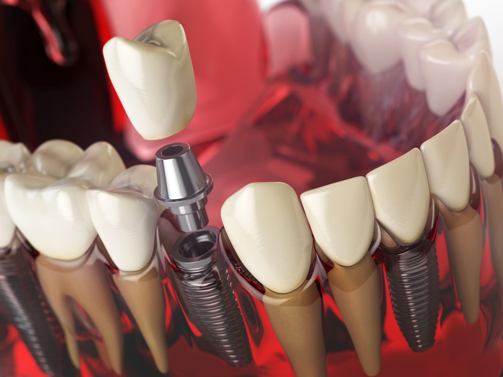 Dental implants